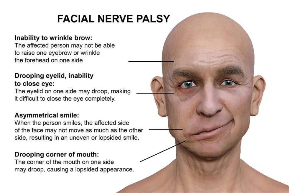 Bells Palsy
